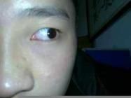 如何防治红眼病？？
