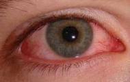 如何防治红眼病？？