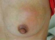 乳房皮肤病可能导致哪些后果