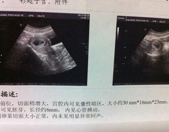 怀孕以后，看B超单上的这些数据，就知道孩子性别！