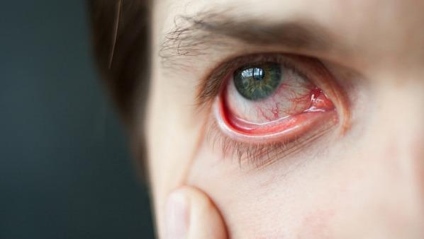 为什么眼睛里总有红血丝？除了疲劳还有这些原因