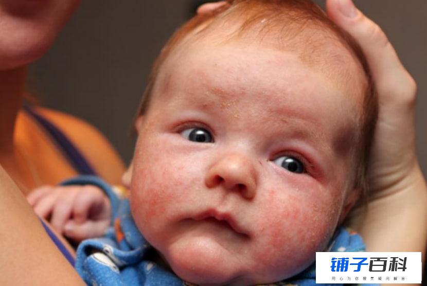 怎么护理有湿疹的宝宝
